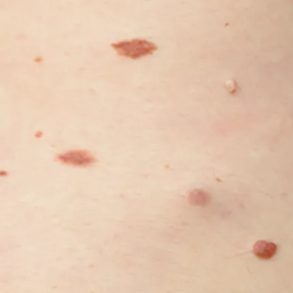 Skin Tag, Wart and Milia Removal