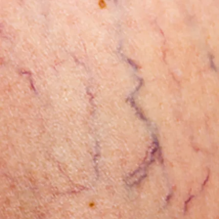 Vein Minimisation and Removal